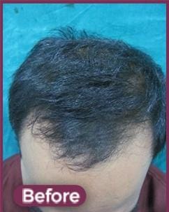 PRP Before
